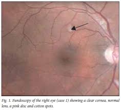 Image result for HIV Retinitis