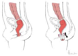 Image result for Rectal prolapse