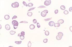 Vererbte strukturanomalie des hämoglobins (roter blutfarbstoff). Sichelzellanamie Hamatologie Und Onkologie Msd Manual Profi Ausgabe