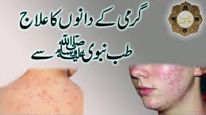 Hum ap ko garmi dano ka illaj ka totka bataya gay.garmi danay paseenay… Garmi Dano Ka Ilaj Prickly Heat Ka Ilaj Prickly Heat Treatment Ù¾Ø±Ú©Ø´Ø´ Ú¯Ø±Ù…ÛŒ Ú©Ø§ Ø¹Ù„Ø§Ø¬ Youtube