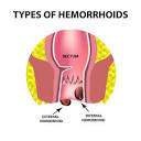 Hemorrhoids (Piles): Types, Symptoms, Causes, Treatment