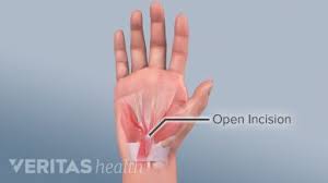 Recovery Milestones For Carpal Tunnel Release Surgery Carpal Tunnel Carpal Tunnel Syndrome Carpal Tunnel Surgery Recovery