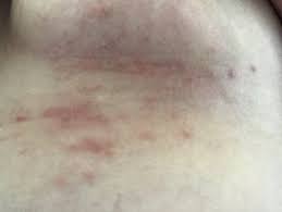 Image result for heat rash under breasts