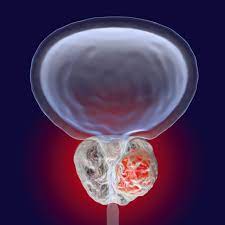 Despite this, pancreatic cancer is among the deadliest types of cancer, which is why it's extremely important to know and recogni. Signs And Symptoms Of Prostate Cancer Onco Com