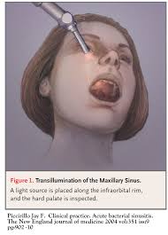 Chemotherapy as palliative therapy to relieve symptoms and improve the quality of life. Sinusitis Cancer Therapy Advisor