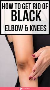 14 Home Remedies To Get Rid Of Black Knees And Elbow Does Having Dark Knee Caps And Elbows Make You Conscious Dark Elbows Summer Skin Care Tips How To Get Rid