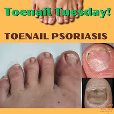 Image result for Pitting nails feet