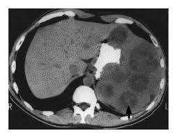Image result for Splenic Abscess