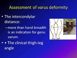 Image result for Genu Varum