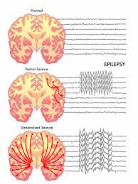 While the exact cause of the seizure may not be known, the more. Seizure Overview Harvard Health