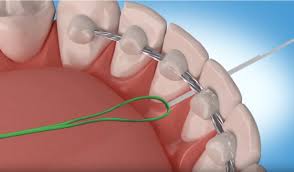 How to floss with braces. How To Floss With A Permanent Retainer Premier Orthodontics