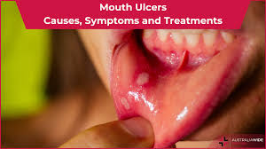 Image result for Mouth ulcers symptoms roof of the mouth