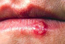 Check spelling or type a new query. Picture Of Cold Sores Fever Blisters Picture Image On Rxlist Com