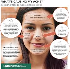 Why do i have acne in my forehead? What Is Causing My Acne News Uab