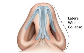 The lateral wall of each nasal cavity mainly consists of the maxilla. Nasal Valve Collapse St Louis Mo Nasal Valve Collapse Treatment