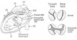 Image result for Endocardial Cushion Defect