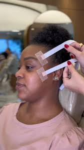 Fios Silhouettes: Lifting Facial Sem Volumização