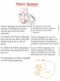 Pyloric Stenosis My Baby Had This Took 4 Weeks From Birth To