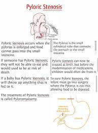 pyloric stenosis my baby had this took 4 weeks from birth to