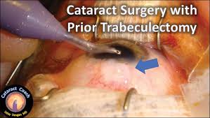 You'll probably have another ophthalmologist appointment around that time. Cataract Surgery In Patients Older Than 90 Years