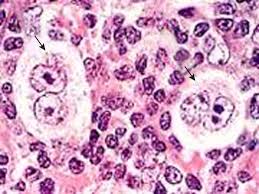 We did not find results for: Linfoma De Hodgkin Del Nino Y Del Adolescente Sciencedirect