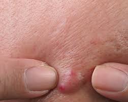 Image result for Skin Abscess