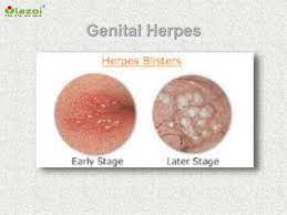 Hsv 2 is a dangerous disease in the sense that, once a person gets the virus. Genital Herpes