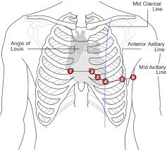 It is important at the time of measurement not only to prevent sagging of the measuring tape, but also not to overtighten (the fat layer allows this). Chest Leads Ecg Lead Placement Normal Function Of The Heart Cardiology Teaching Package Practice Learning Division Of Nursing The University Of Nottingham