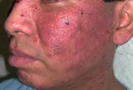 Photodermatologic Disorders