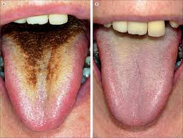 Image result for black hairy tongue symptoms