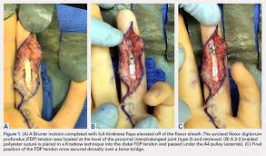 One states flexor tendon and the other. A Novel Technique For The Treatment Of Jersey Fingers Mdedge Surgery