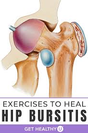 9 Best Exercises For Hip Bursitis Best Exercise For Hips Hip Bursitis Exercises Bursitis Hip