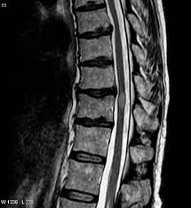 Transverse myelitis (tm) is a heterogeneous focal inflammatory disorder of the spinal cord characterised by acute or subacute development of motor weakness, sensory impairment, and autonomic dysfunction. Transverse Myelitis Wikipedia