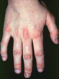 Non sono note strategie per prevenire la comparsa di una malattia autoimmune. Miosite Autoimmune Disturbi Di Ossa Articolazioni E Muscoli Manuale Msd Versione Per I Pazienti