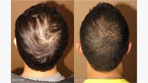 Stem cell therapy for hair growth. Neograft Hair Transplant Benefits Side Effects How It Works