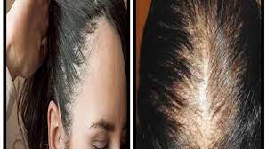 علاج الشعر الخفيف من الأمام في أقل من الأسبوع mysit