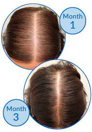 Woman Gives Honest Account Of Hair Loss From Pcos