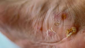 Image result for pompholyx soles of feet