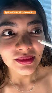 Ácido Hialurónico: Corrección y Aplicación Segura