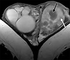 Image result for Genitourinary Tuberculosis