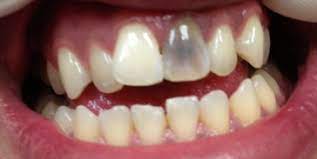 Dying trees can be saved, if and only when you know how to prevent the progression of the problem. Walking Dead Tooth Costa Mesa Dentist
