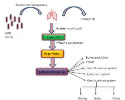 Image result for Genitourinary Tuberculosis