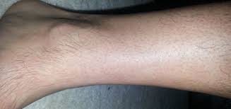 Hair loss from your arms and legs is especially important to report because it could be a sign of poor blood flow. Learn Why Hair Loss On Legs Happen And Causes With Treatment