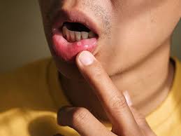 Image result for Mouth ulcers roof of mouth