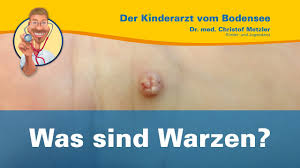 Die methode eignet sich beispielsweise nicht für. Dornwarzen Bei Kindern Infos Zur Entfernung Und Behandlung Der Warzen