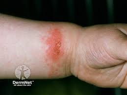 Image result for contact dermatitis