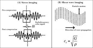 Ultrasound Elastography In The Evaluation Of Thyroid Nodules