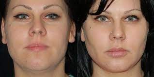 Buccal fat removal ranges between $2,000 and $5,000. Buccal Fat Removal Forum Community Message Board Realself
