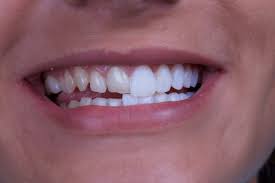Porcelain veneers are more expensive than the indirect or direct composite resin alternative. How Much Do Veneers Cost