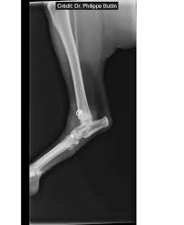 Reconstruction of tarsal medial collateral ligament - Novetech Surgery